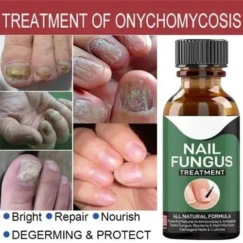 Fast Nail Fungus Treatment Serum